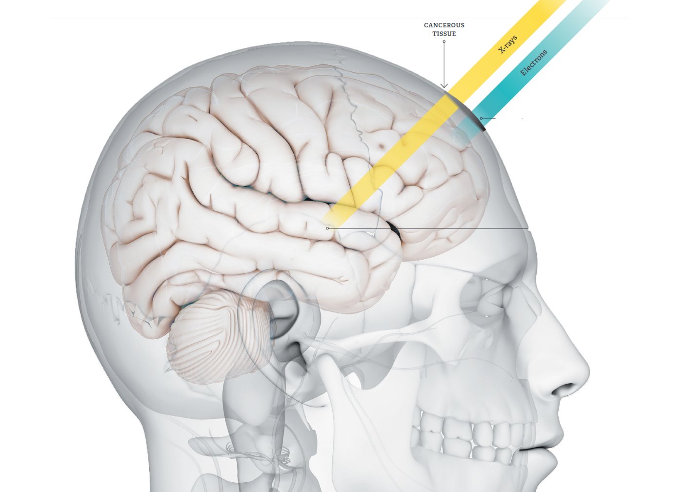 IntraOp
