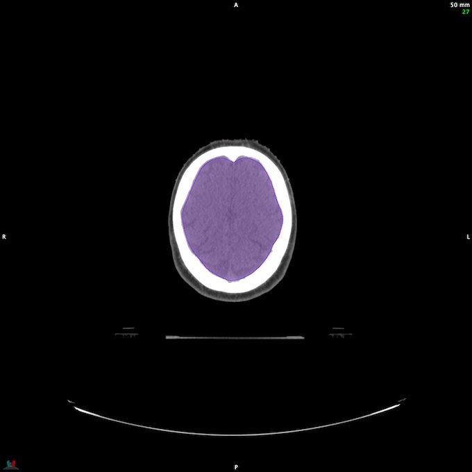 CT__BRAIN_10
