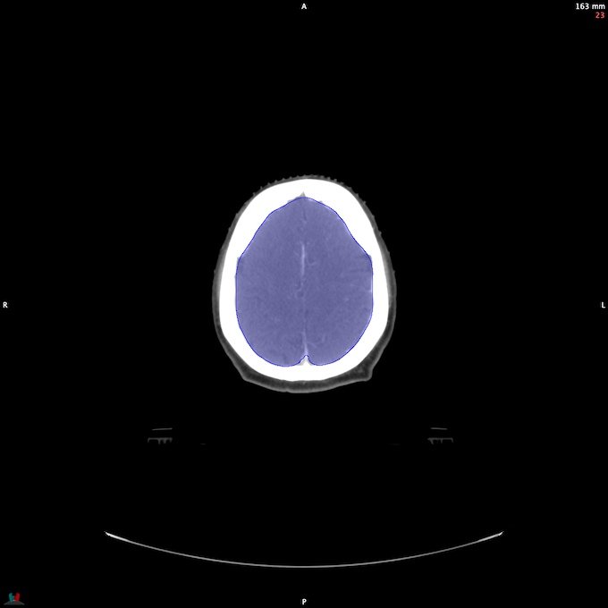 CT__BRAIN_14