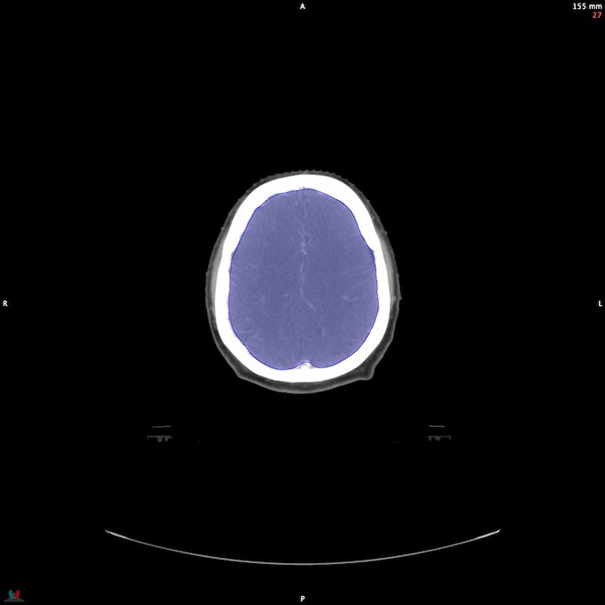CT__BRAIN_18