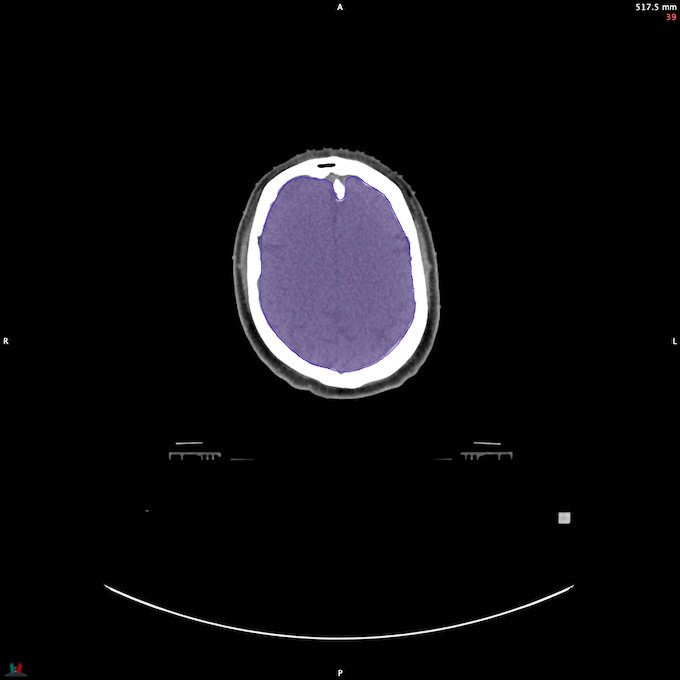 CT__BRAIN_19