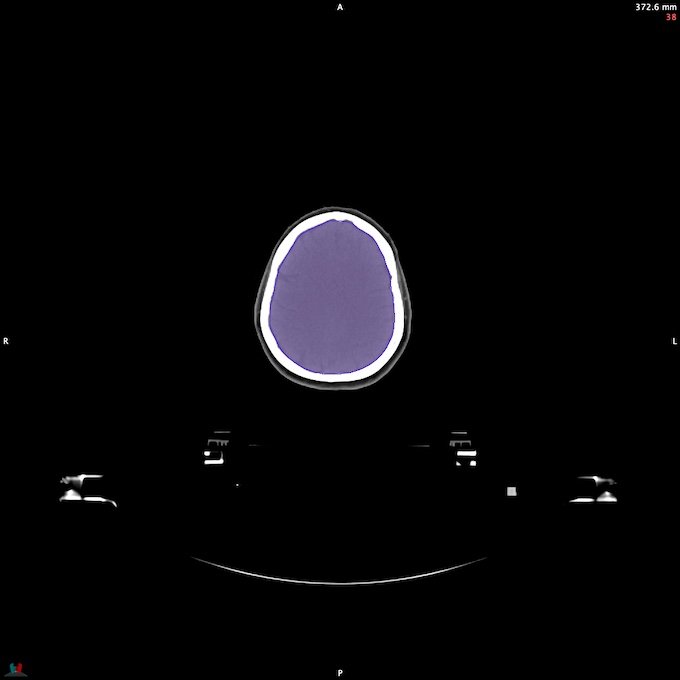 CT__BRAIN_19