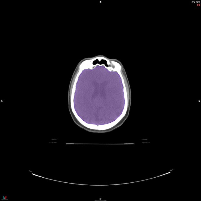 CT__BRAIN_20