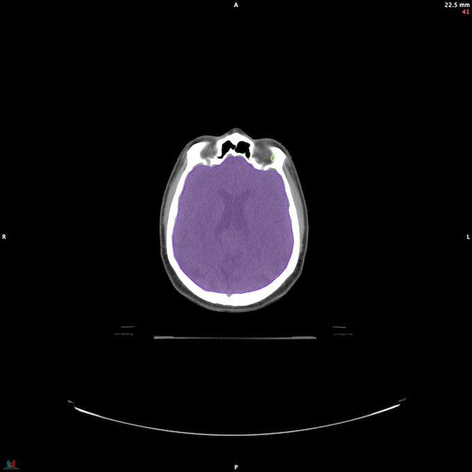 CT__BRAIN_21