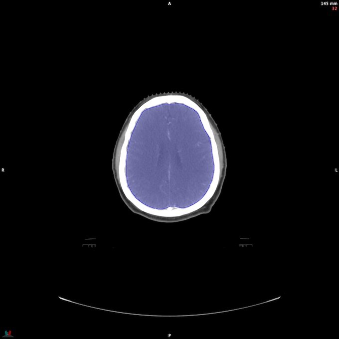 CT__BRAIN_23
