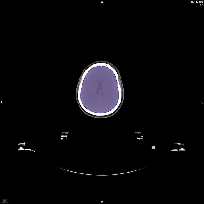 CT__BRAIN_23