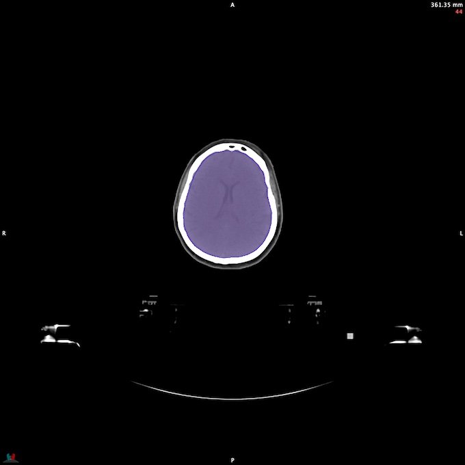 CT__BRAIN_24