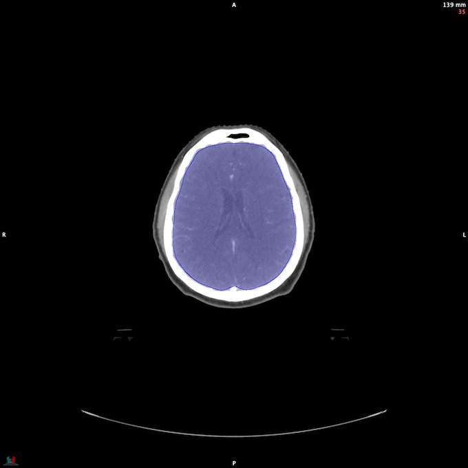 CT__BRAIN_26