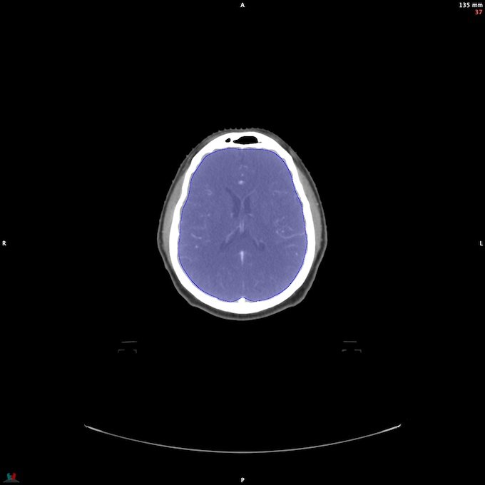 CT__BRAIN_28