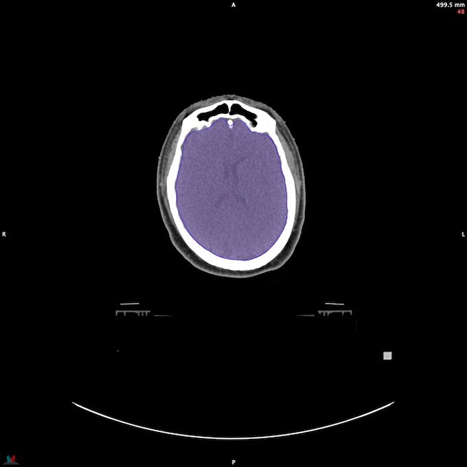 CT__BRAIN_28