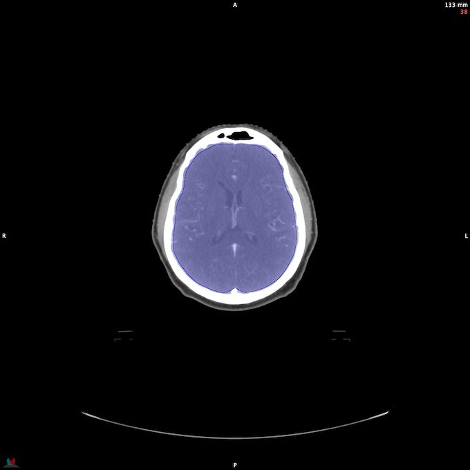 CT__BRAIN_29