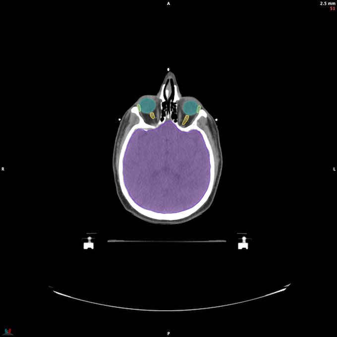 CT__BRAIN_29