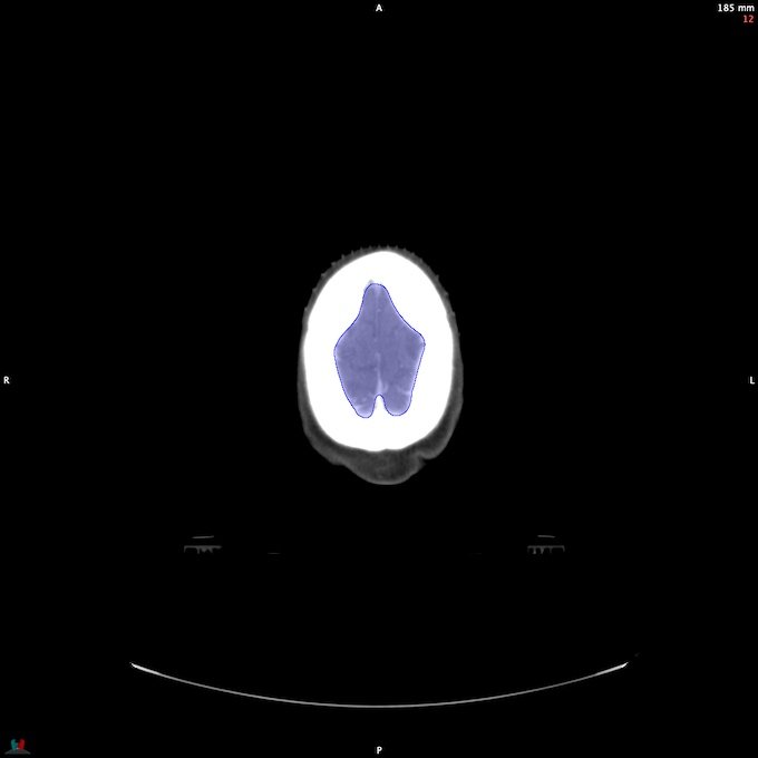 CT__BRAIN_3