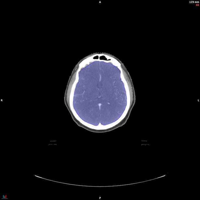 CT__BRAIN_31