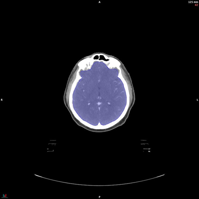 CT__BRAIN_33