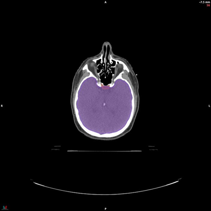 CT__BRAIN_33