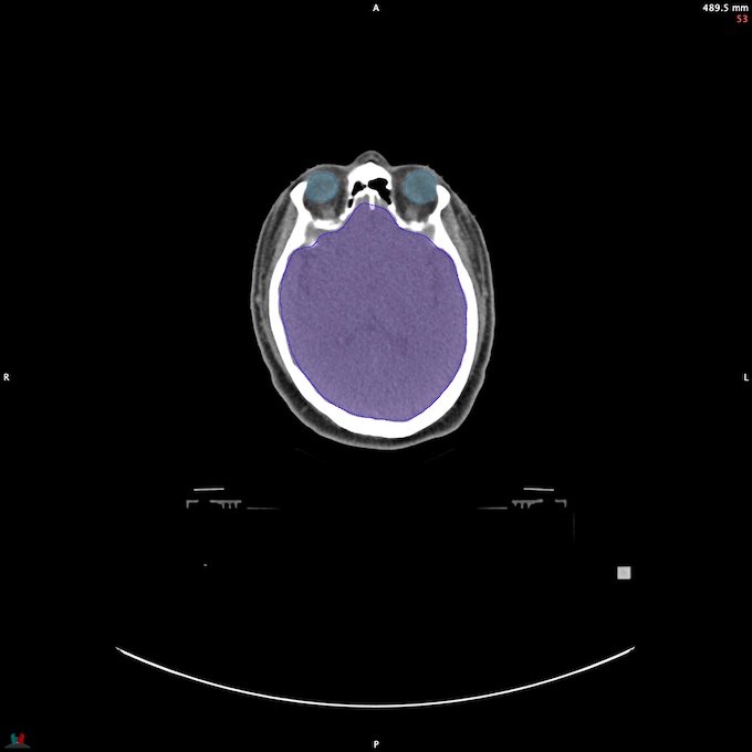 CT__BRAIN_33