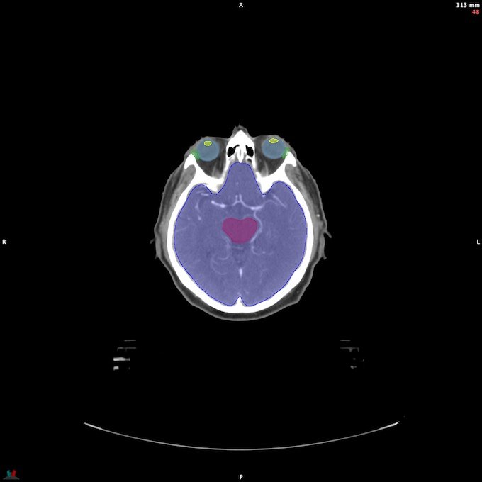 CT__BRAIN_39