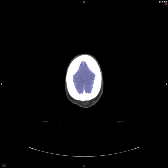 CT__BRAIN_4