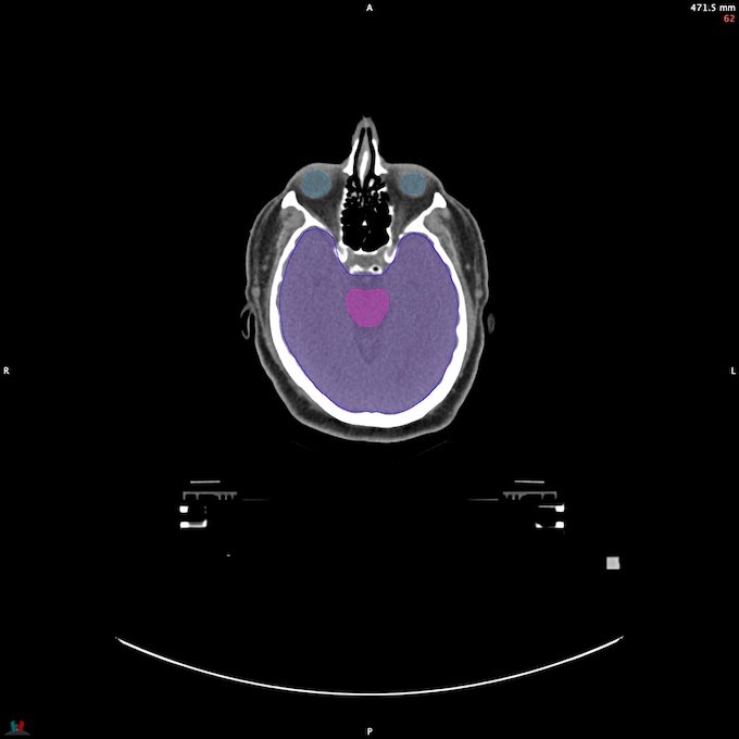 CT__BRAIN_42