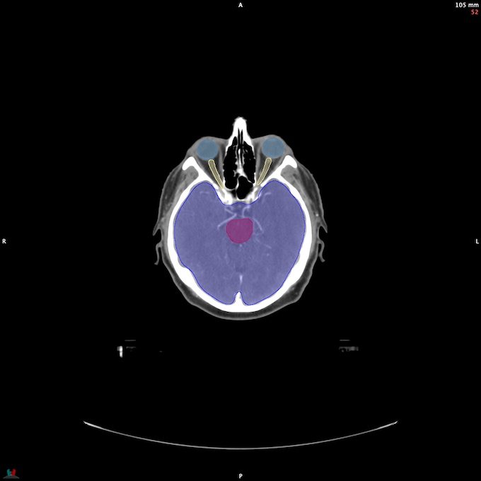 CT__BRAIN_43