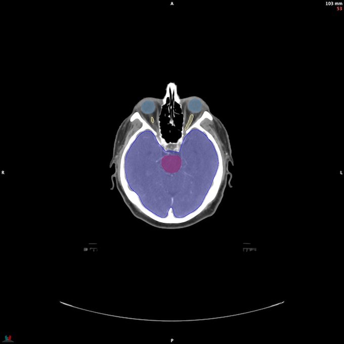 CT__BRAIN_44