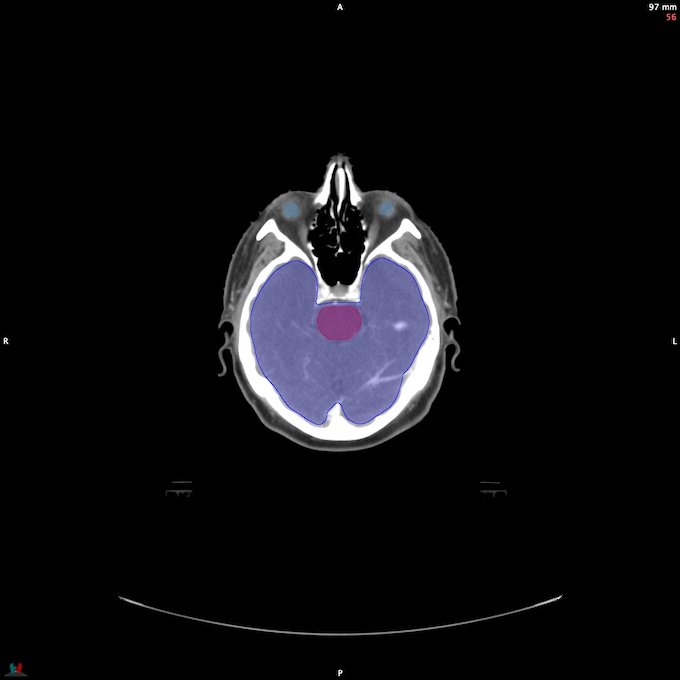 CT__BRAIN_47