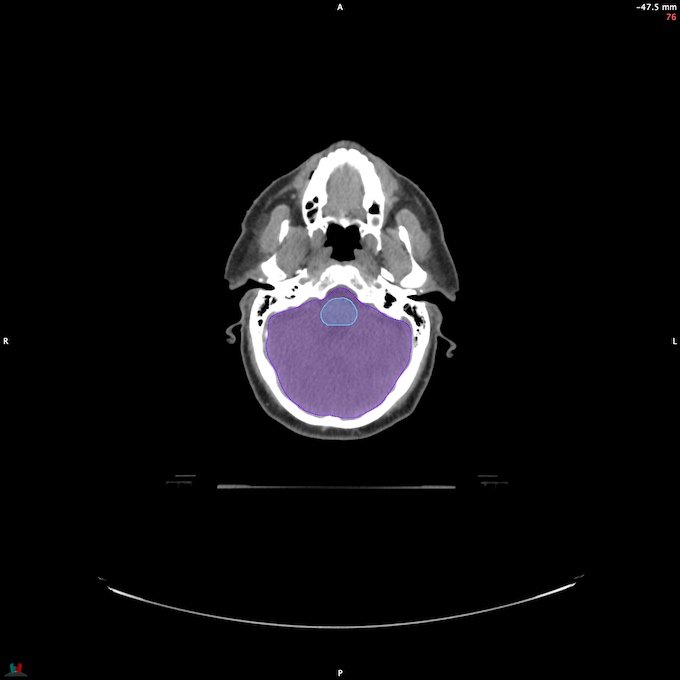 CT__BRAIN_49