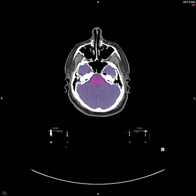 CT__BRAIN_49
