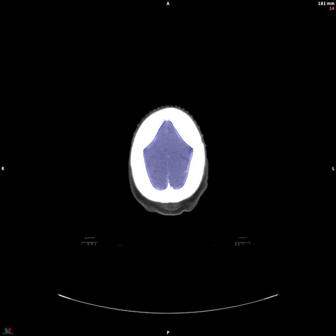 CT__BRAIN_5