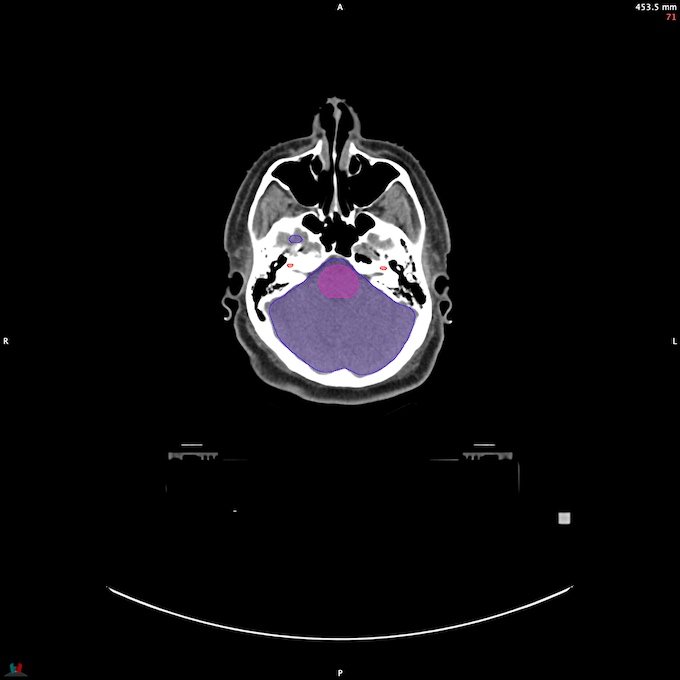 CT__BRAIN_51