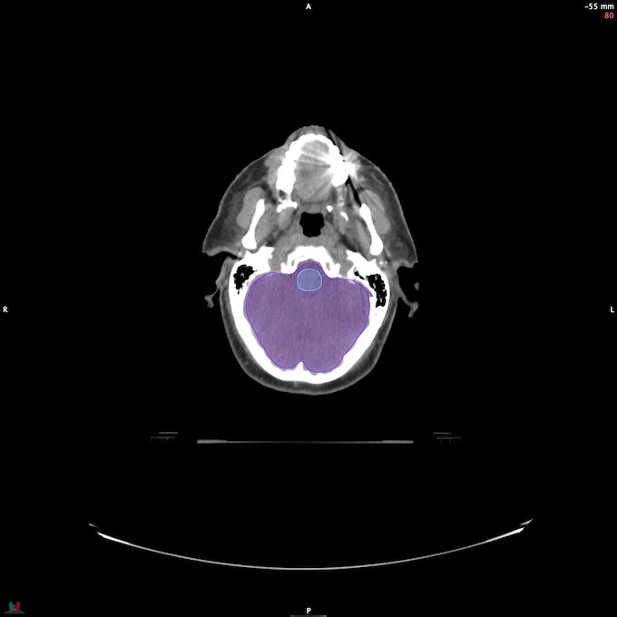 CT__BRAIN_52