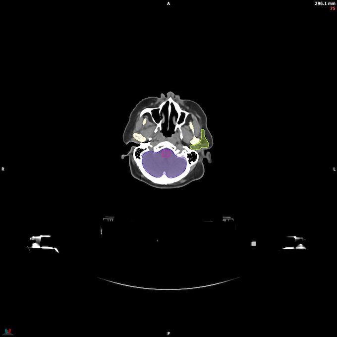 CT__BRAIN_53