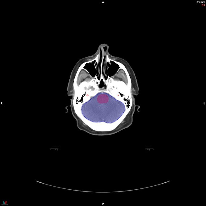 CT__BRAIN_54