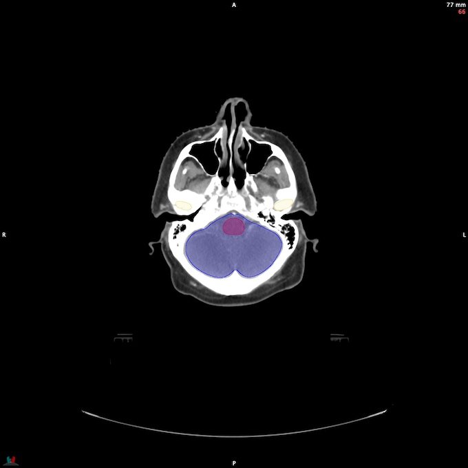 CT__BRAIN_57