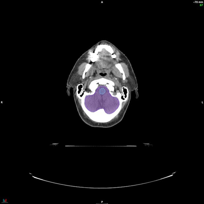 CT__BRAIN_58