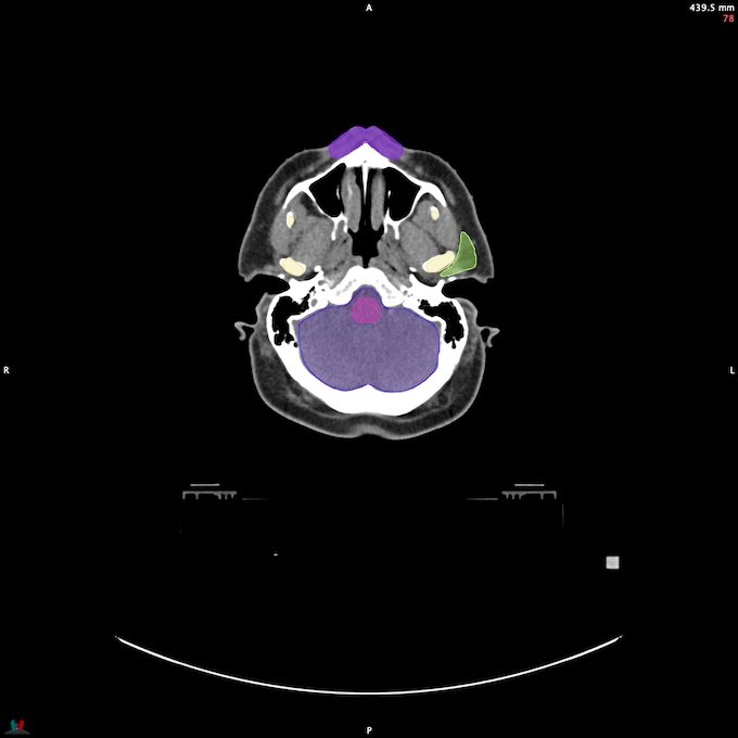 CT__BRAIN_58