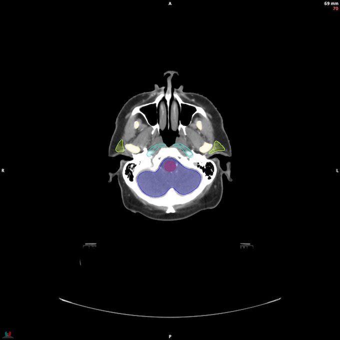 CT__BRAIN_61