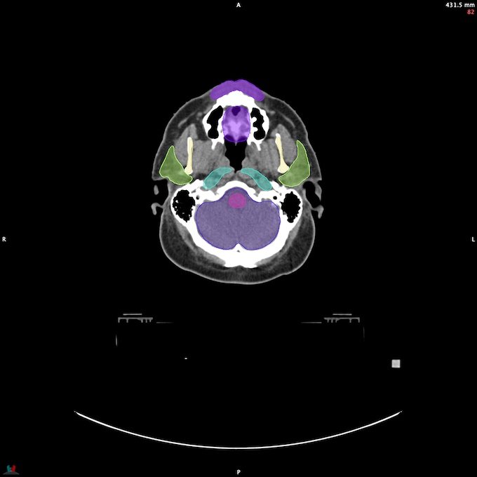 CT__BRAIN_62