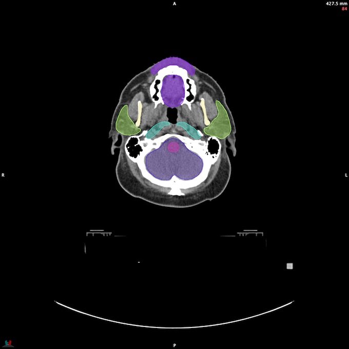 CT__BRAIN_64