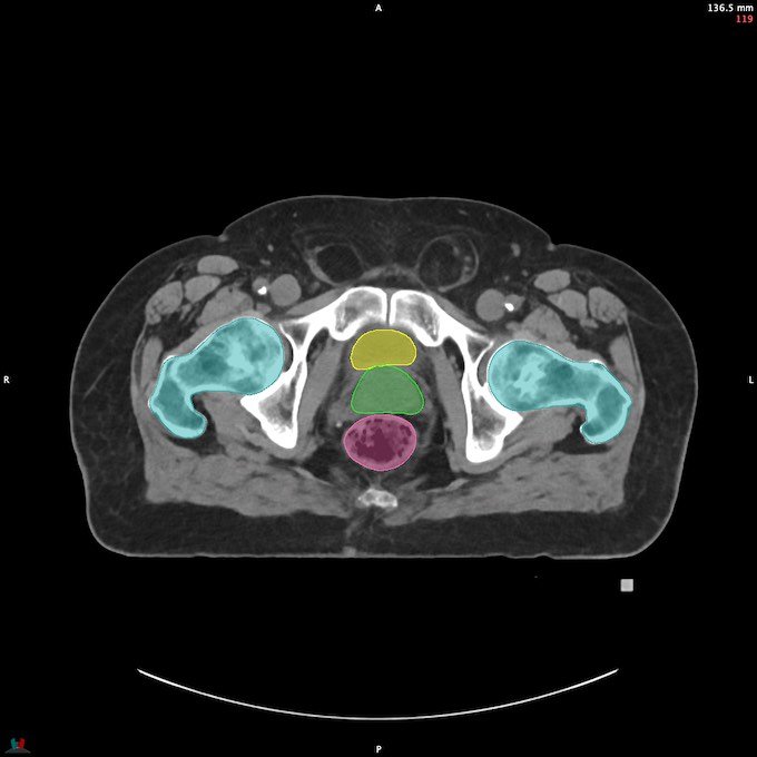 CT__FEMUR_L_17