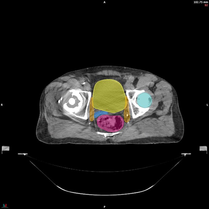 CT__FEMUR_L_3