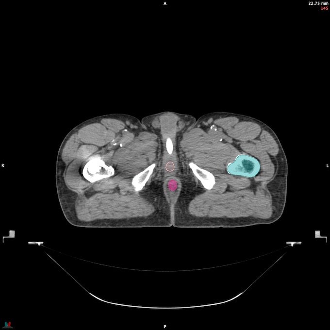 CT__FEMUR_L_35