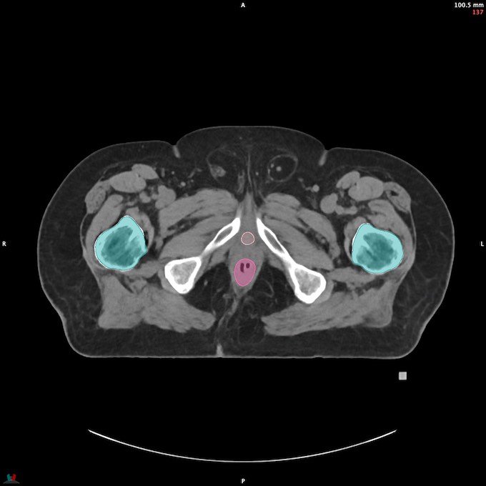 CT__FEMUR_L_35