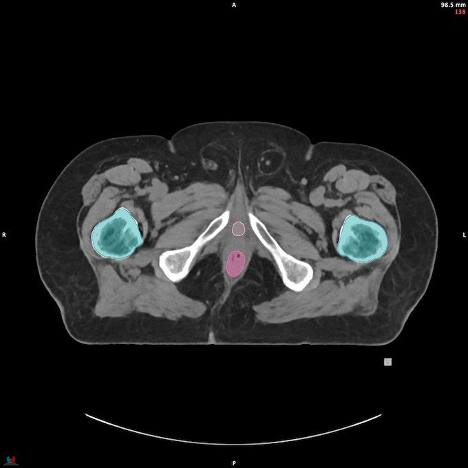 CT__FEMUR_L_36