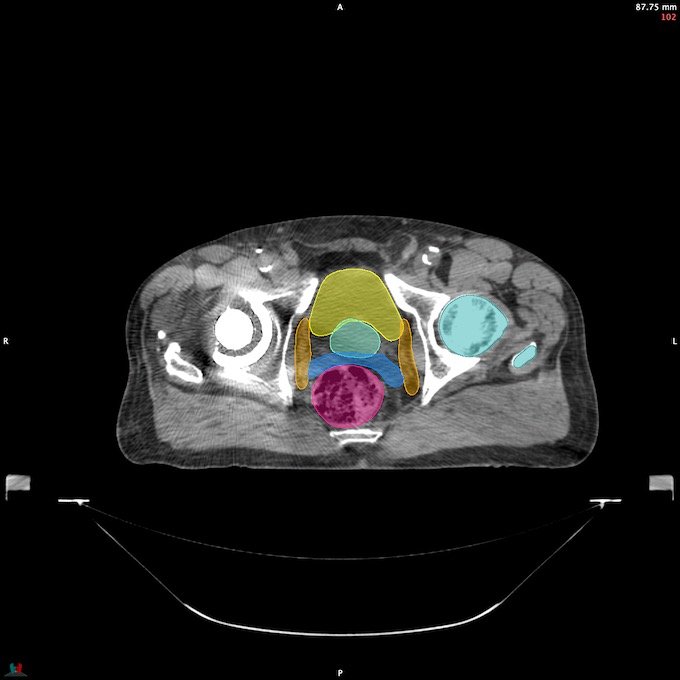 CT__FEMUR_L_9