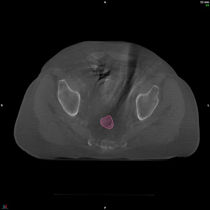 CT__RECTUM_CBCT_0