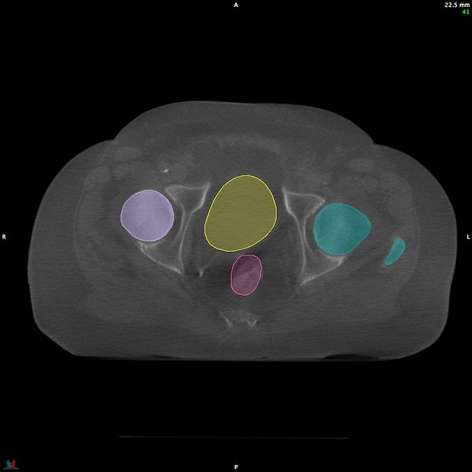 CT__RECTUM_CBCT_13