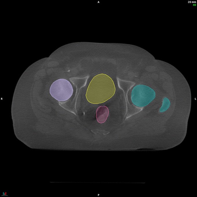 CT__RECTUM_CBCT_14