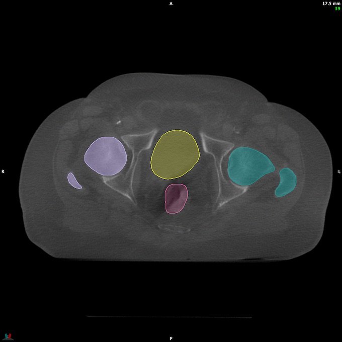 CT__RECTUM_CBCT_15